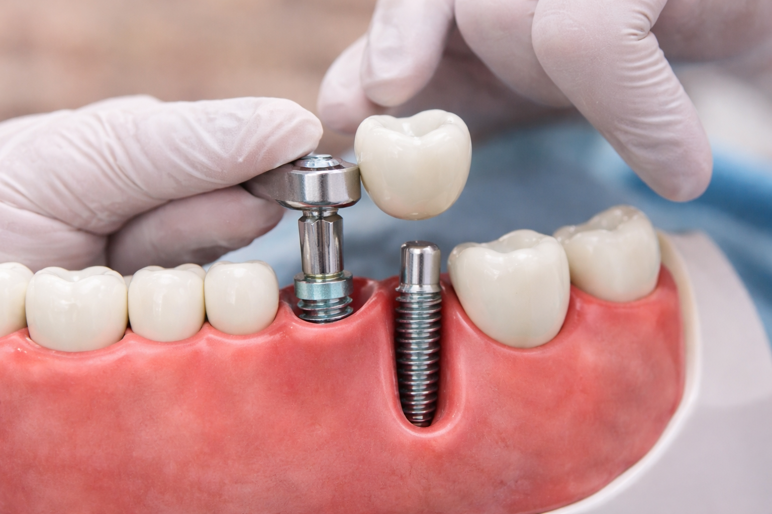 Dental Implant In near by