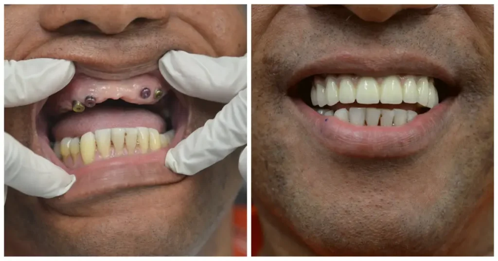 Implant Dental